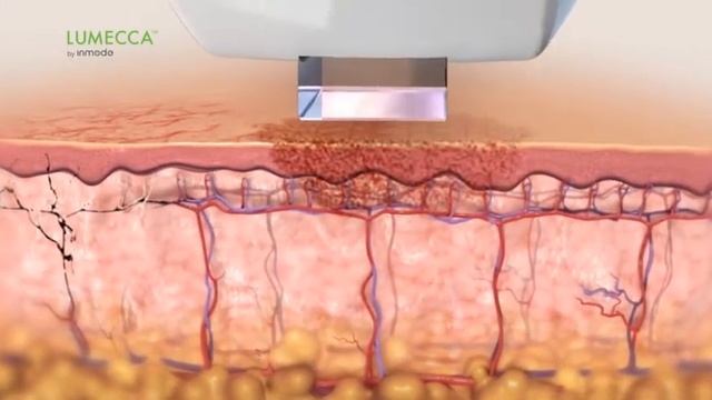 Lumecca IPL treatment by InMode - Skintique Clinic смотреть онлайн