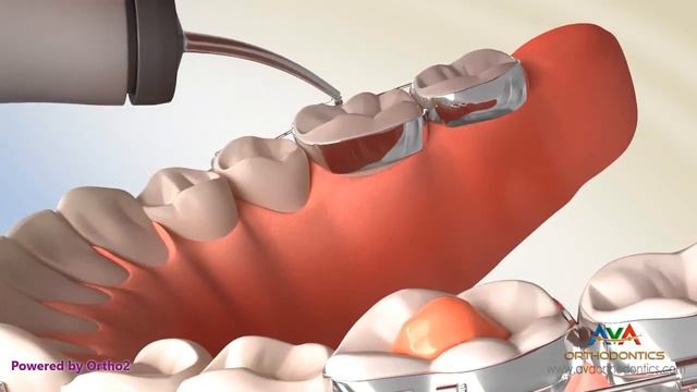 Posterior Bite Block - Orthodontic Treatment смотреть онлайн