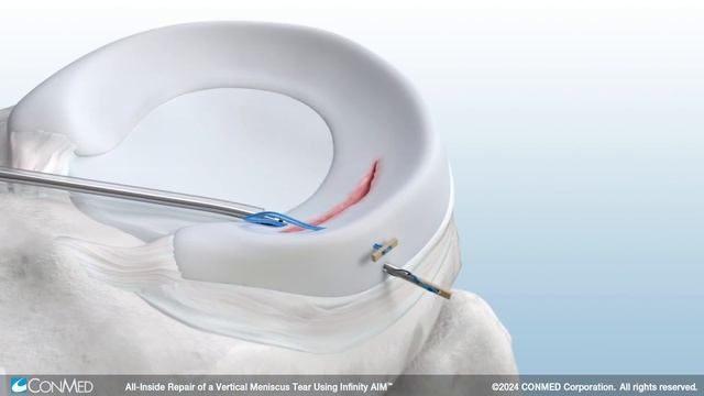 All-Inside Repair Of Vertical Meniscus Tear Using Infinity AIM™ - CONMED Animation