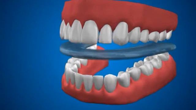 Бруксизм сжимание зубов во сне Стирание эмали Боль в мышцах и суставах смотреть онлайн