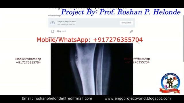 Bone Fracture Detection Using Image Processing With Source Code | Python Project Fracture Detection смотреть онлайн