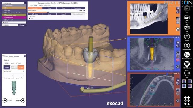 Презентация Exocad Exoplan и Guide Creator от Олега Воловикова на стенде ARTICON (Дентал Салон 2019