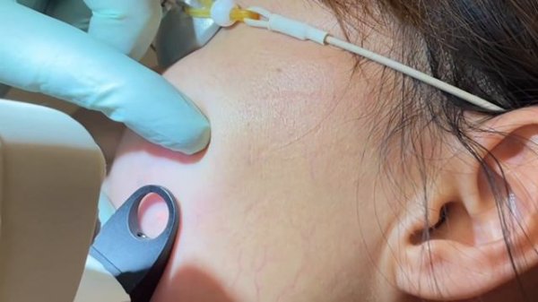 Dissolved cyst follow up #2. 4 week and 6 week follow up. Additional YAG laser to vessels today.