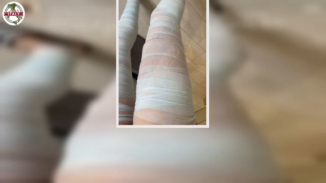 Amici 20, Ex Ballerina Con Tutte Le Gambe Fasciate Salta Fuori La Foto Inedita