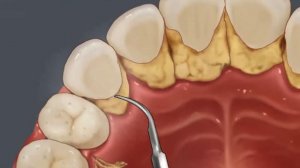 ASMR анимация удаления зубного камня | Чистка исчисления | Стоматологический скейлинг. Stop motion
