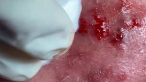 Make your Acne Treatment Huong Da Nang | 446 # acne 2022