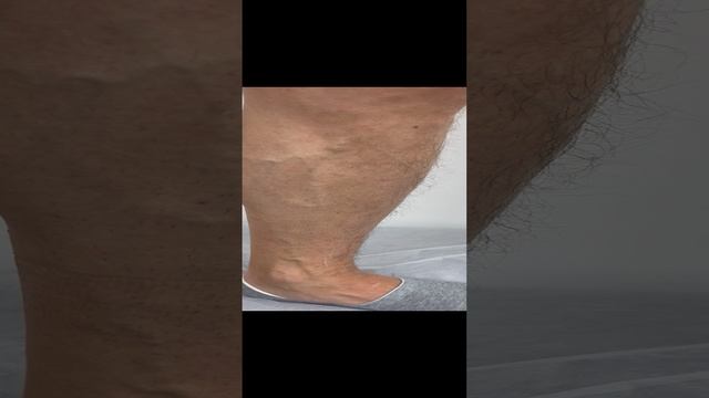 Тазовый варикоз. Варикоз на ногах. Варикоцеле. Флеболог Москва. Флеболог. Диагностика в Москве