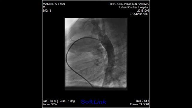 Baby Ariyan 2 11 Yrs 12 Kg Large PDA Aortogram Lateral Angio Show RFV Technique смотреть онлайн