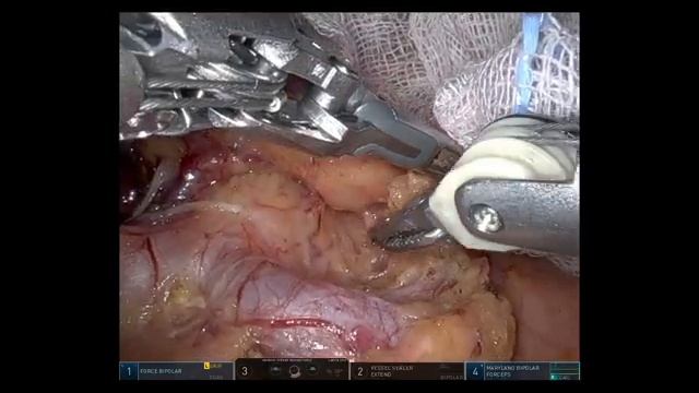 reduced ports robotic pylorus preserving gastrectomy at Seoul National University Bundang Hospital смотреть онлайн