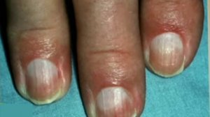 Что говорят ногти о здоровье. Диагноз по ногтям. Здоровье. Diagnosis by nails