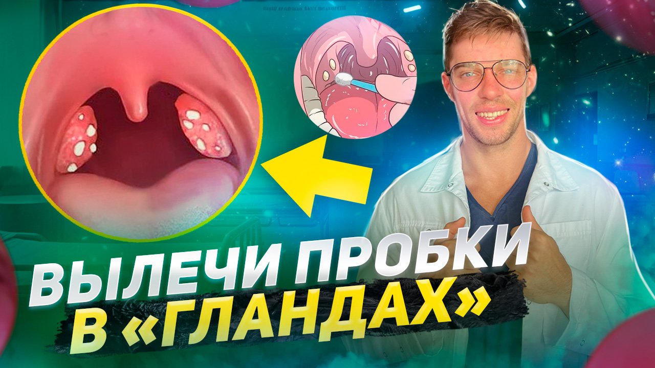 Пробки в «гландах», миндалин и лечение в домашних условиях хронического тонзиллита. смотреть онлайн