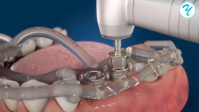 Имплантация зубов без боли и разрезов. смотреть онлайн