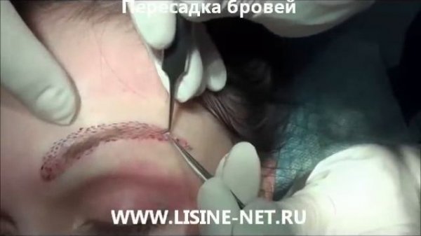 Lisine-net - пересадка бровей