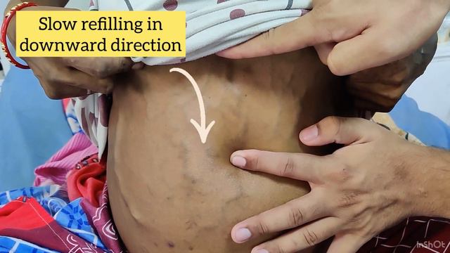 Assess Blood Flow Direction In Dilated Abdominal Veins L Portal-hypertension #liver #medschool