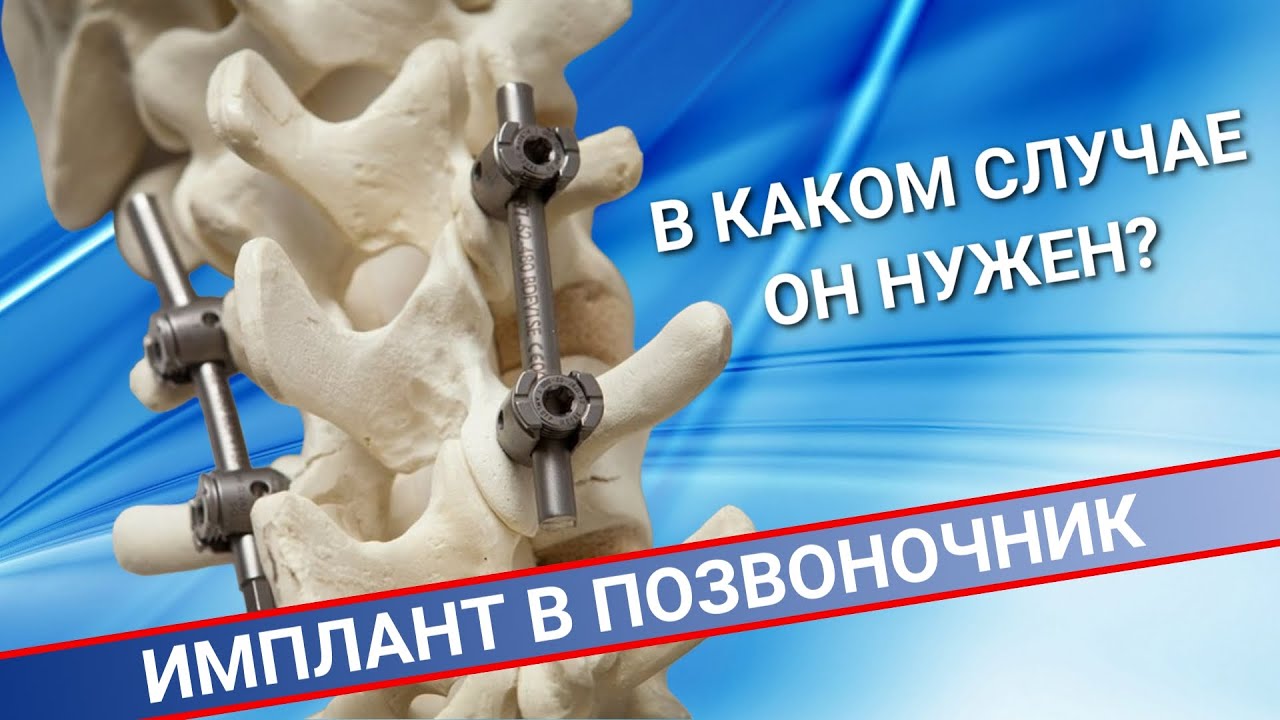 НУЖНО ЛИ СТАВИТЬ ИМПЛАНТ В ПОЗВОНОЧНИК? смотреть онлайн