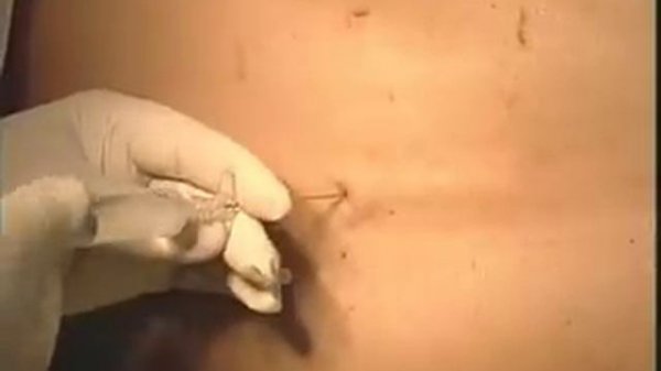 Эпидуральный катетер - epidural katheter