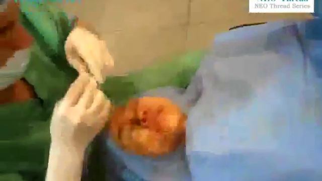 Мезонити NEO, Лицо — ПОЛНАЯ ПРОЦЕДУРА, часть 2 (NEO Thread Operation 2 Face) смотреть онлайн