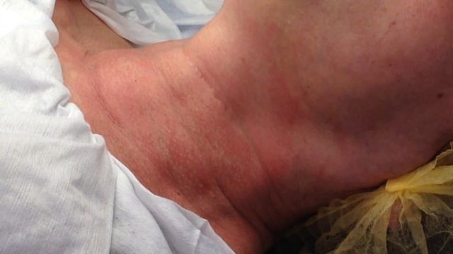 Меди лайт Филлеры заполнение морщин область шеи смотреть онлайн