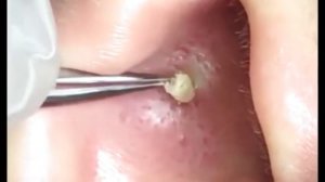 ПРЫЩ В УХЕ|ACNE IN THE EAR