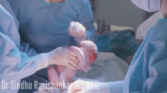 Cesarean delivery (C-section) explained in Kannada | Indications for LSCS | Dr Sindhu Ravishankar смотреть онлайн