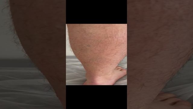 Неудачная лазерная операция ЭВЛК дважды. Как лечить варикоз? Флеболог Москва. Флеболог #флеболог смотреть онлайн