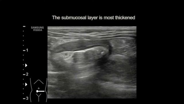 Tumor of the descending colon in a 6 month old cat смотреть онлайн