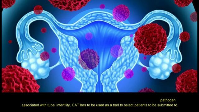 Investigation on Tubal Infertility and Chlamydia Trachomatis in a Congolese Infertile Population смотреть онлайн