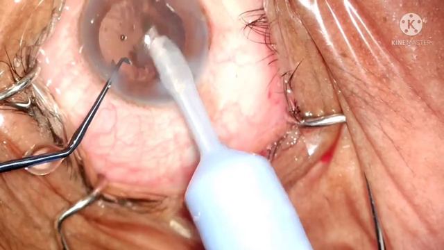 Phacoemulsification of NS 2-3 cataract by direct chop on Stellaris PC смотреть онлайн