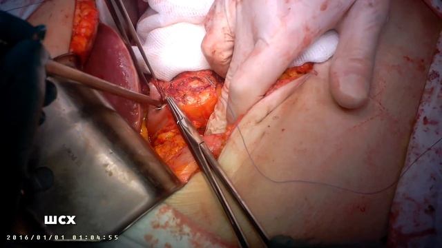 Ушивание культи 12-перстной кишки смотреть онлайн