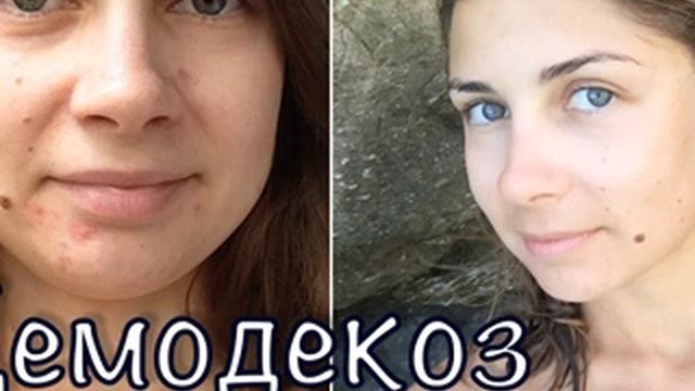 Сера горючая, деготь и сало- и демодекоза не стало смотреть онлайн