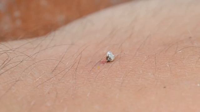 Как удалить пчелиное жало смотреть онлайн