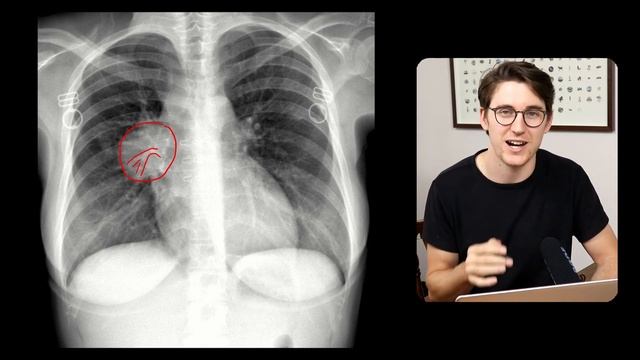 Hilum overlay sign explained смотреть онлайн