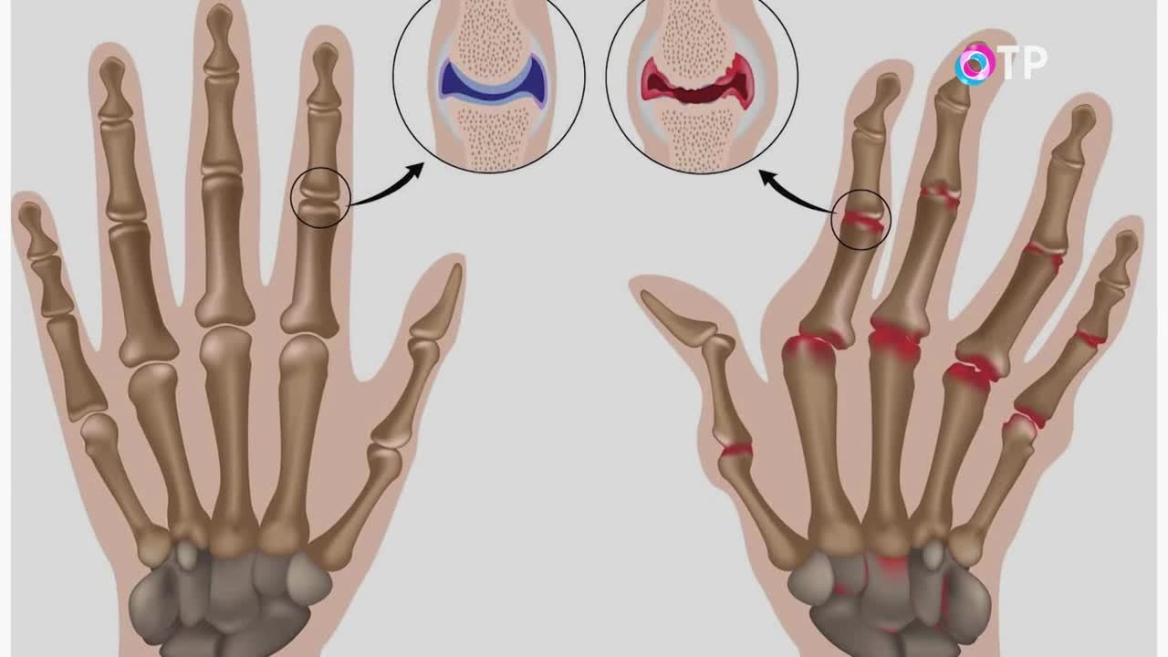 Ревматоидный артрит. Как предотвратить заболевание?
