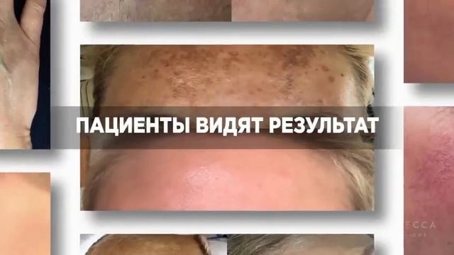 Фотоомоложение LUMECCA смотреть онлайн