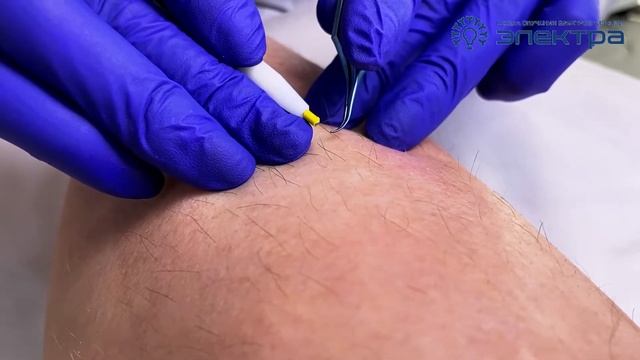 Обзор пинцетов для электроэпиляции / Виды пинцетов / Пинцет для электролога смотреть онлайн