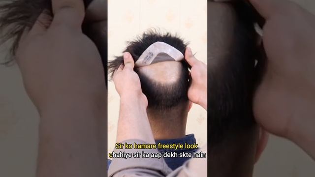 HAIR TRANSPLANT! YES OR NO? смотреть онлайн