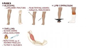 Синдром длительного сдавления (Краш-синдром)
