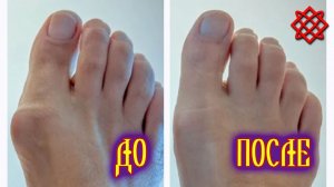 Как Избавиться от Косточки на Ноге Народными Средствами.  Лечение в домашних условиях.mp4