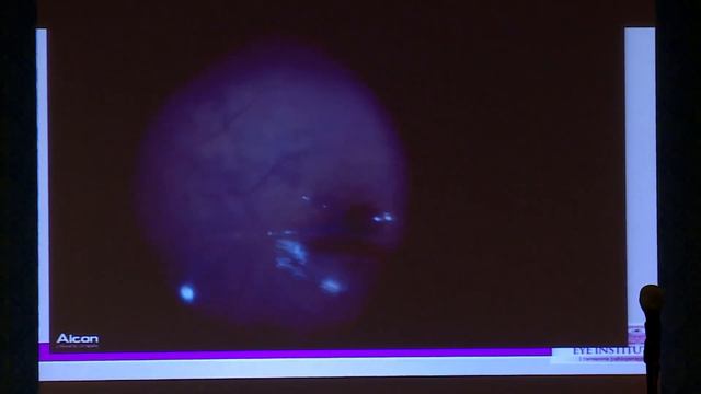 AIOC2019 - GP085 - Great Debates ( Posterior Segment ) смотреть онлайн