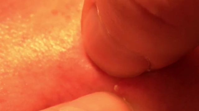 Внимание не повторять. Давим угри на лице там где нельзя давить. Лечение угревой сыпи.