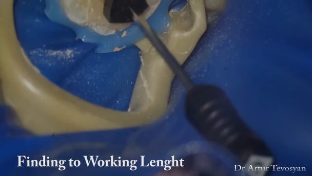 Retreatment 3.7 (red Russian cement) - Перелечивание резорцин-формалинового зуба смотреть онлайн