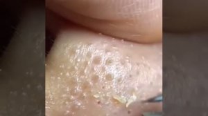 Чистка носа от угрей