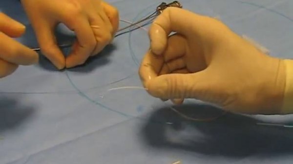 Использование балончатого катетера