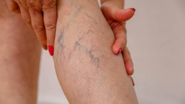 Варикоз ужасно боится этих домашних средств! Чем лечить варикоз дома, если... смотреть онлайн