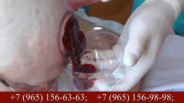 Здоров 100 лет - центр натуропатии. Хиджама (Обучающие курсы) смотреть онлайн