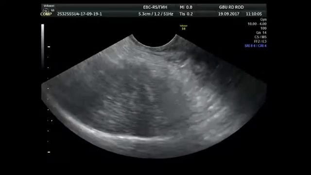 образование мягких тканей малого таза смотреть онлайн