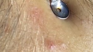 Satifying videos for Relaxation| чёрные точки | прыщи выдавливание| акне |угри