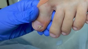 Врос ноготь на ноге /Не правильно стриг ногти /Что делать, если врос ноготь?Тампонада вросшего ногт