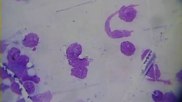 Морфология лимфатических опухолей Раздел1 смотреть онлайн