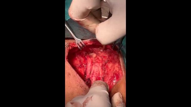 Inguinal lymph nodes disection in a case of malignant melanoma of foot смотреть онлайн